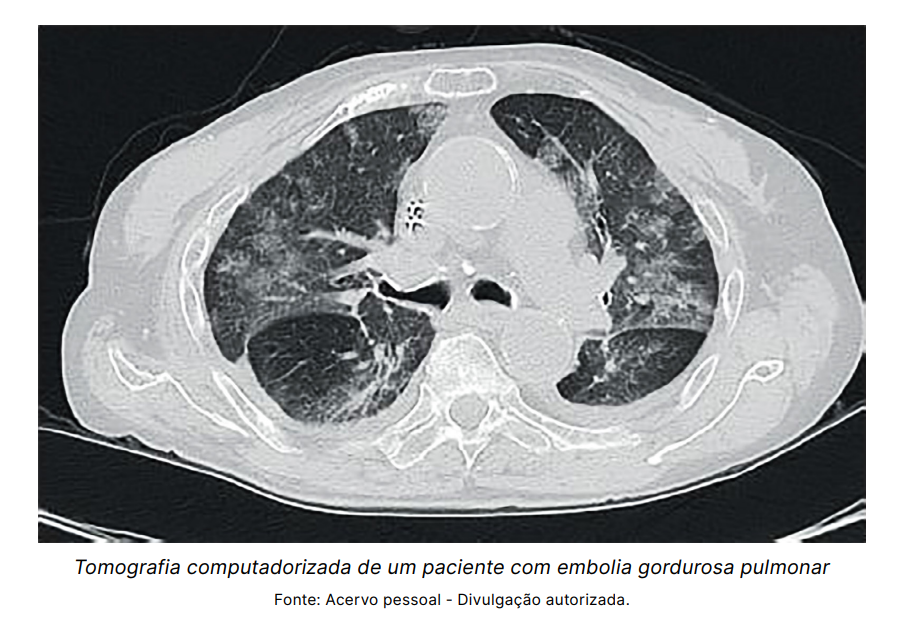 Tomografia computadorizada de um paciente com embolia gordurosa pulmonar